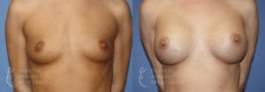 Patient 49a Breast Augmentation Before and After