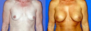 Patient 50a Breast Augmentation Before and After
