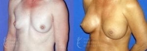 Patient 50b Breast Augmentation Before and After