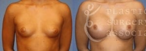 Patient 51a Breast Augmentation Before and After