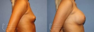 Patient 51b Breast Augmentation Before and After