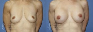 Patient 53a Breast Augmentation Before and After