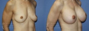 Patient 53b Breast Augmentation Before and After