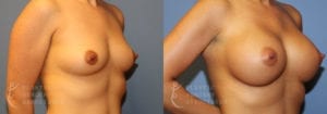 plastic-surgery-associates-san-francisco-breast-augmentation-patient-54-2