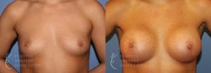 Patient 55a Breast Augmentation Before and After