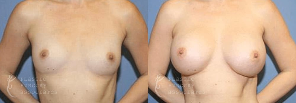 Patient 7a Breast Augmentation Before and After
