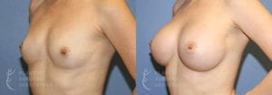 Patient 7b Breast Augmentation Before and After