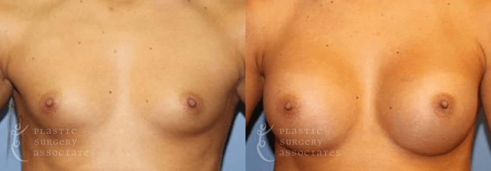 Patient 8a Breast Augmentation Before and After