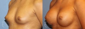 Patient 8b Breast Augmentation Before and After