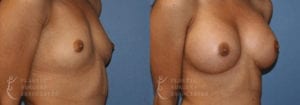 Patient 9b Breast Augmentation Before and After