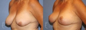 Patient 10 Mommy Makeover Before and After Left Oblique View