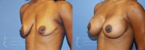 Patient 12 Mommy Makeover Before and After Left Oblique View