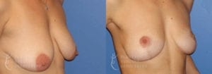 Patient 14 Mommy Makeover Before and After Right Oblique View
