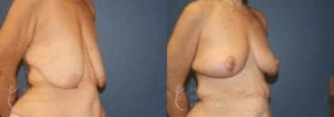 Patient 15 Mommy Makeover Before and After Right Oblique View