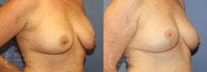 Patient 5 Mommy Makeover Before and After Right Oblique View