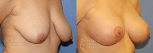 Patient 6 Mommy Makeover Before and After Right Oblique View