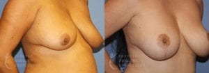 Patient 7 Mommy Makeover Before and After Right Oblique View
