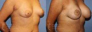 Patient 9 Mommy Makeover Before and After Right Oblique View