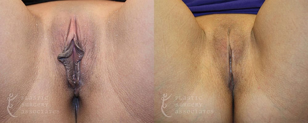 Patient 1 Labiaplasty Before and After