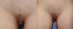 Patient 10a Labiaplasty Before and After