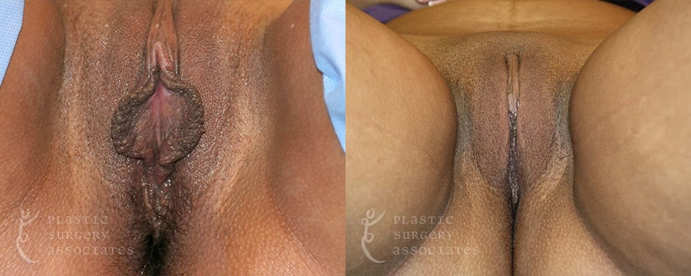 Patient 2 Labiaplasty Before and After