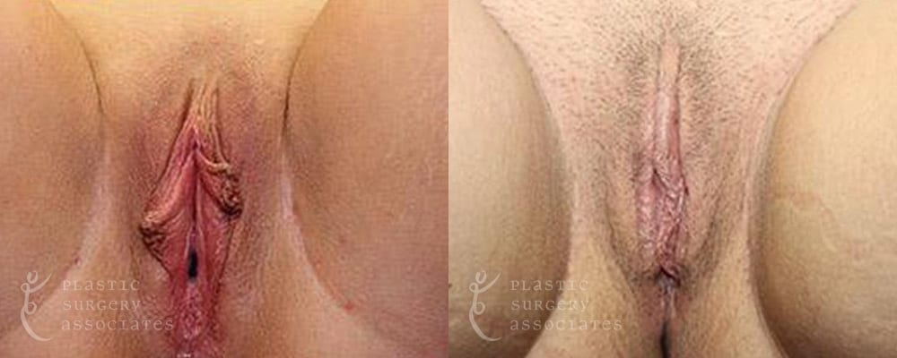 Patient 4 Labiaplasty Before and After