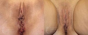 Patient 6a Labiaplasty Before and After