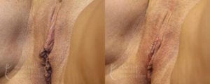 Patient 6b Labiaplasty Before and After