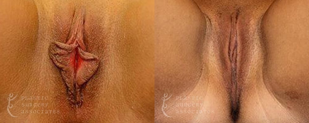 Patient 8 Labiaplasty Before and After