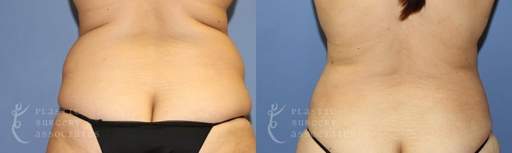 Patient 2 Liposuction Before and After