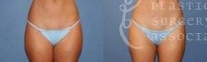 Patient 3 Liposuction Before and After Front View