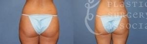 Patient 3 Liposuction Before and After Back View
