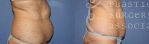 Patient 4 Liposuction Before and After Right Side View