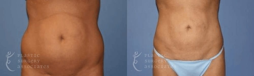 Patient 5 Liposuction Before and After Front View