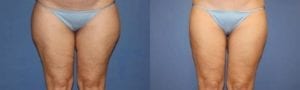 Patient 6 Liposuction Before and After Front View