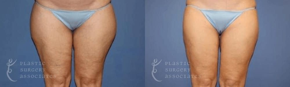 Patient 6 Liposuction Before and After Front View