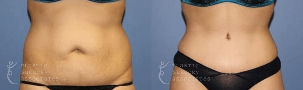 Patient 7 Liposuction Before and After Front View