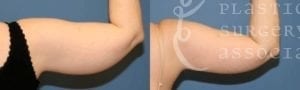 Patient 8 Liposuction Before and After Back Arm View