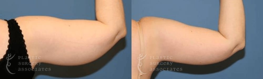Patient 8 Liposuction Before and After Back Arm View