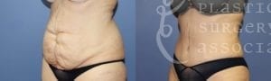Patient 1 Mommy Makeover Before and After Left Oblique View