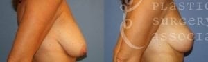 Patient 10 Mommy Makeover Before and After Right Oblique View
