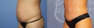 Patient 19 Mommy Makeover Before and After Left Oblique View