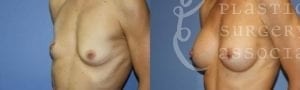 Patient 17 Mommy Makeover Before and After Left Oblique View