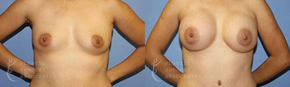 Patient 2 Mommy Makeover Before and After Front Breast View