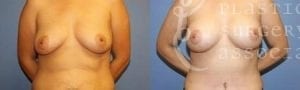 Patient 3 Mommy Makeover Before and After Front Breast View