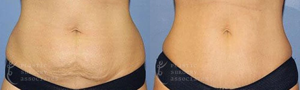 Patient 4 Mommy Makeover Before and After Front Abdominal View