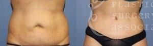 Patient 5 Mommy Makeover Before and After Front Abdominal View