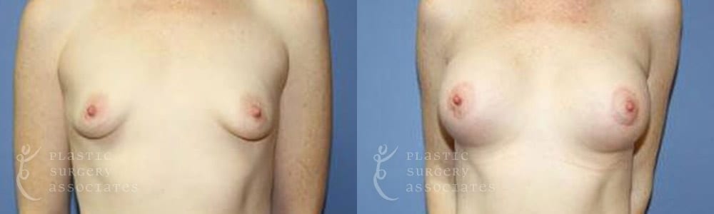 Patient 6 Mommy Makeover Before and After Front Breast View