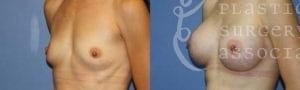 Patient 8 Mommy Makeover Before and After Left Oblique View