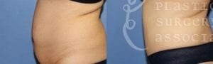 Patient 11b Tummy Tuck Before and After